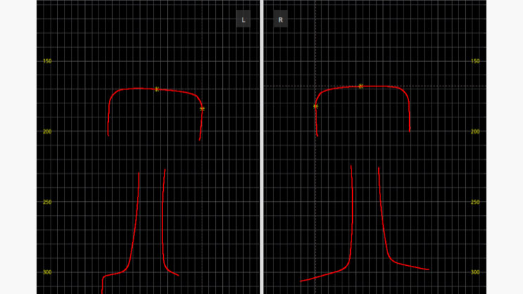 Two red line graphs on a black background, labeled L and R